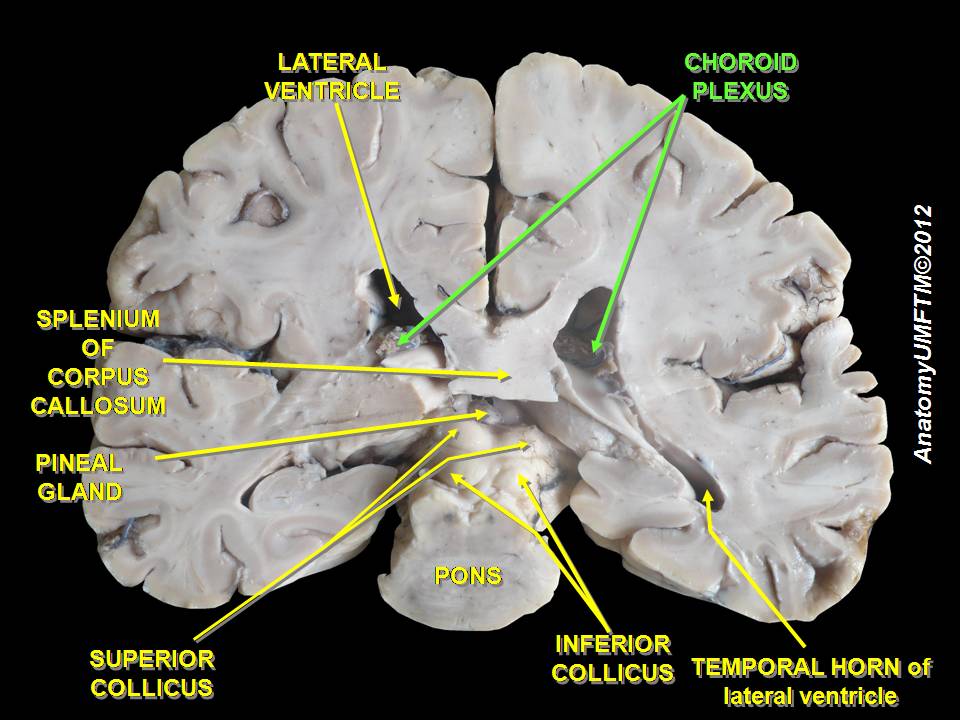 Choroid_plexus_2